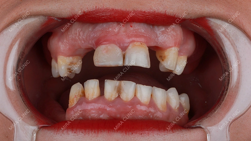 Number of Missing Teeth